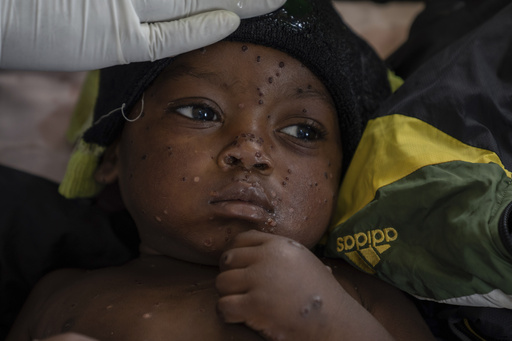 UN Approves First Mpox Vaccine for Kids in Effort to Combat Congo Outbreak