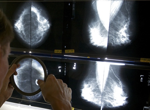 Research indicates that some breast cancer patients may skip specific surgical procedures.