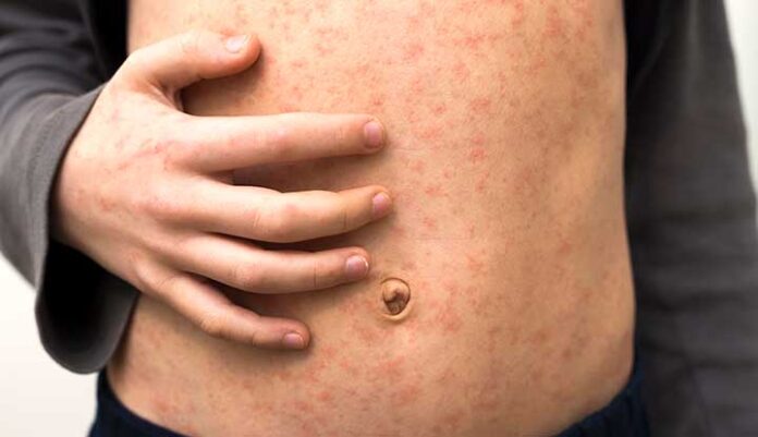 Measles is a contagious virus that causes spots on your skin and fever (Photo: Cleveland Clinic)