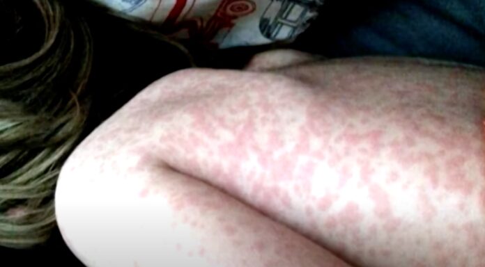 Three Confirmed Measles Cases Prompt Urgent Health Alert in NJ (Photo: CBS New York/YouTube)