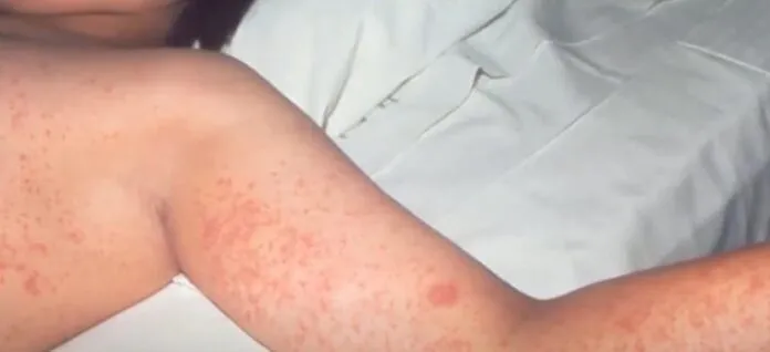 Vaccination urged as measles threaten Wisconsin (Photo: WSAW NewsChannel 7/YouTube)